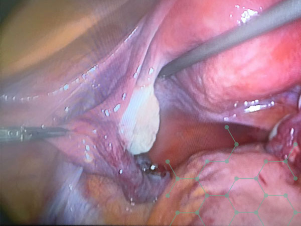 Diagnóstico y tratamiento quirúrgico laparoscópico de quistes en los ovarios