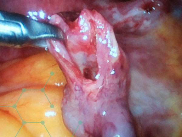 Salpingostomía laparoscópica