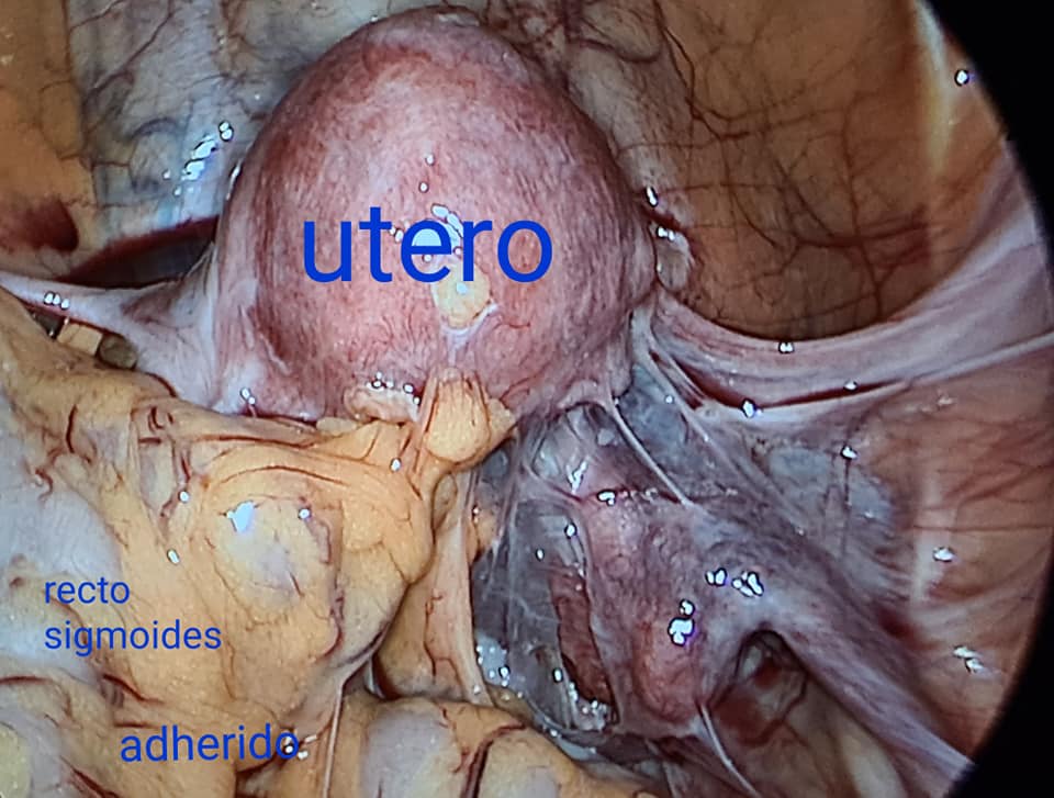 Caso de Endometriosis