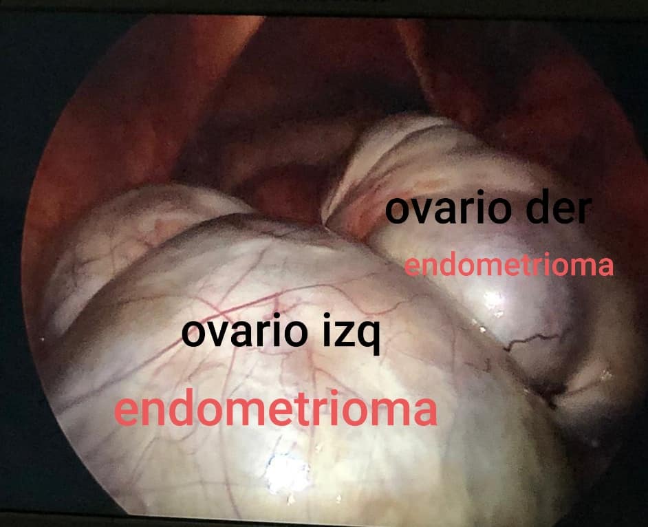 Endometriosis Bilateral