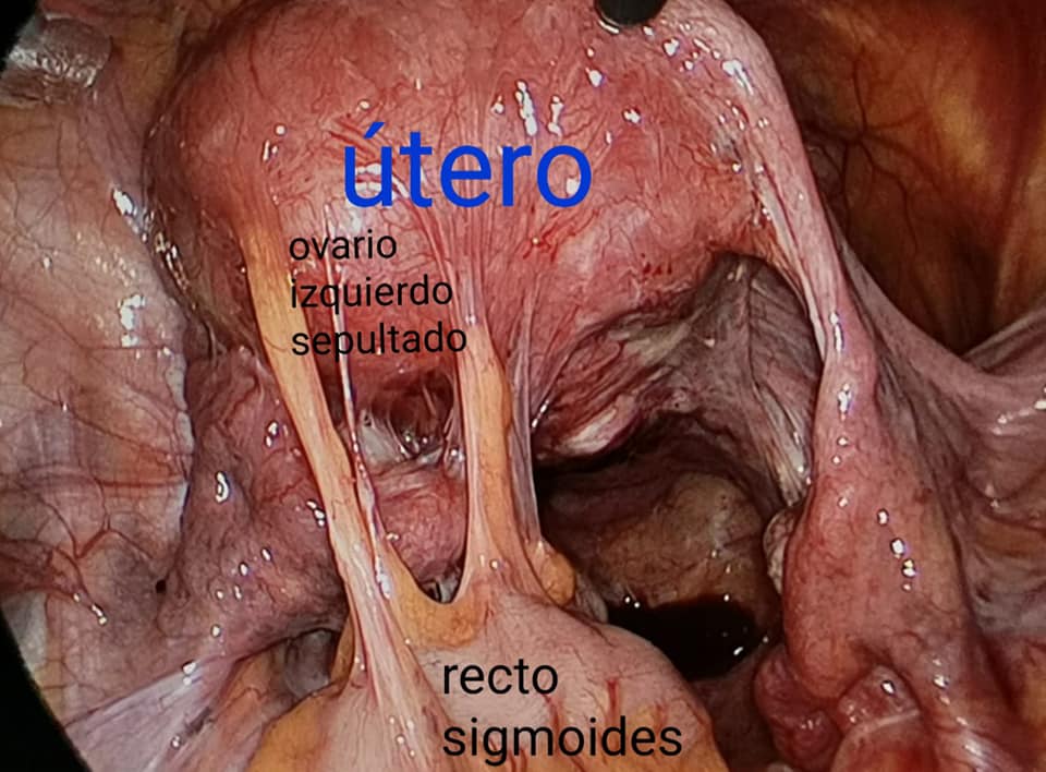 Endometriosis Grado 3