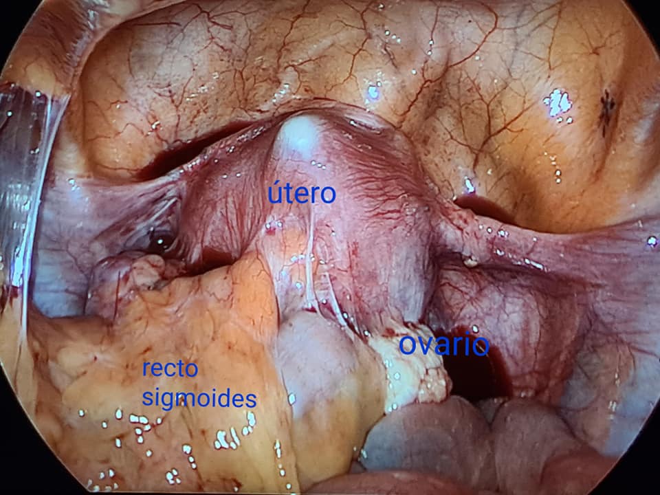 Endometriosis Intestinal