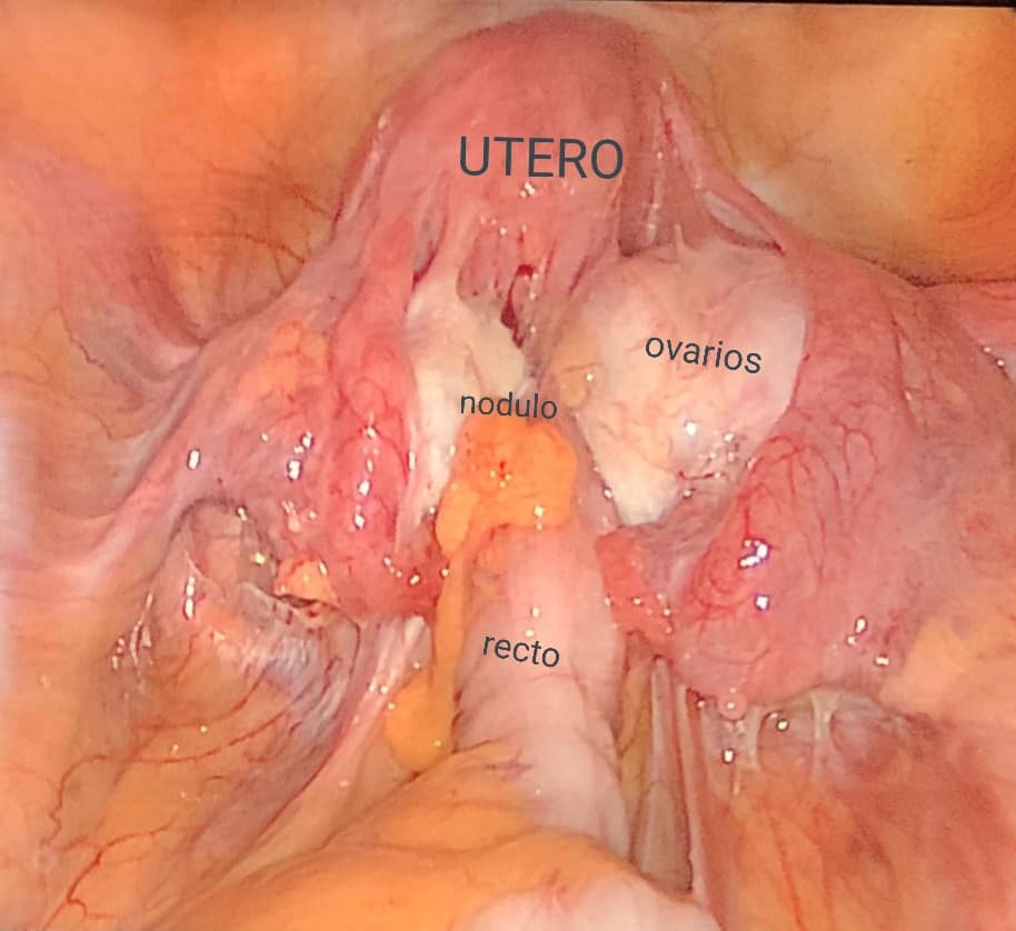 Endometriosis infiltrativa profunda (severa) intestinal y pélvica.