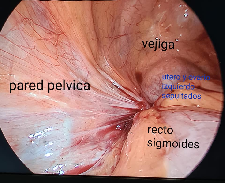 Endometriosis Severa Grado 4