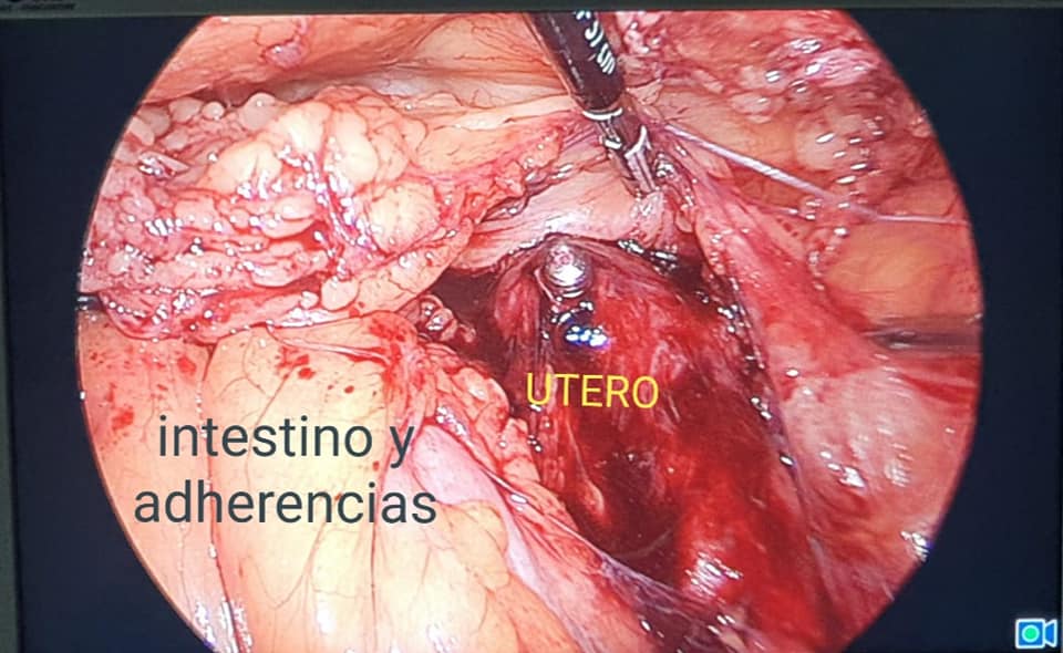 Endometriosis Severa