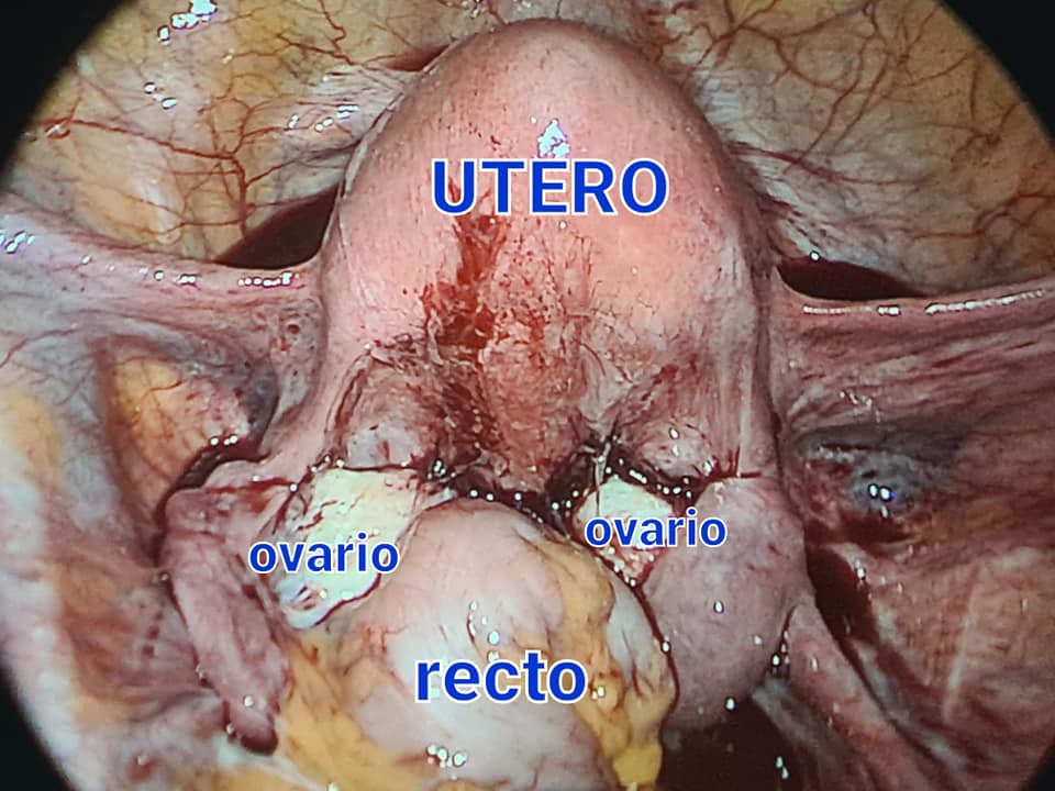 Inicio de cirugía, recto adherido a útero por nódulo endometriosis