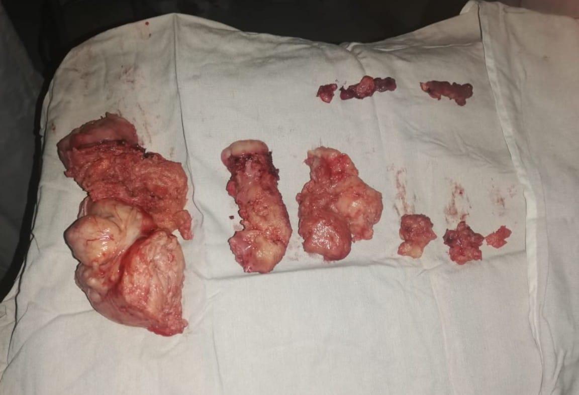 Miomatosis