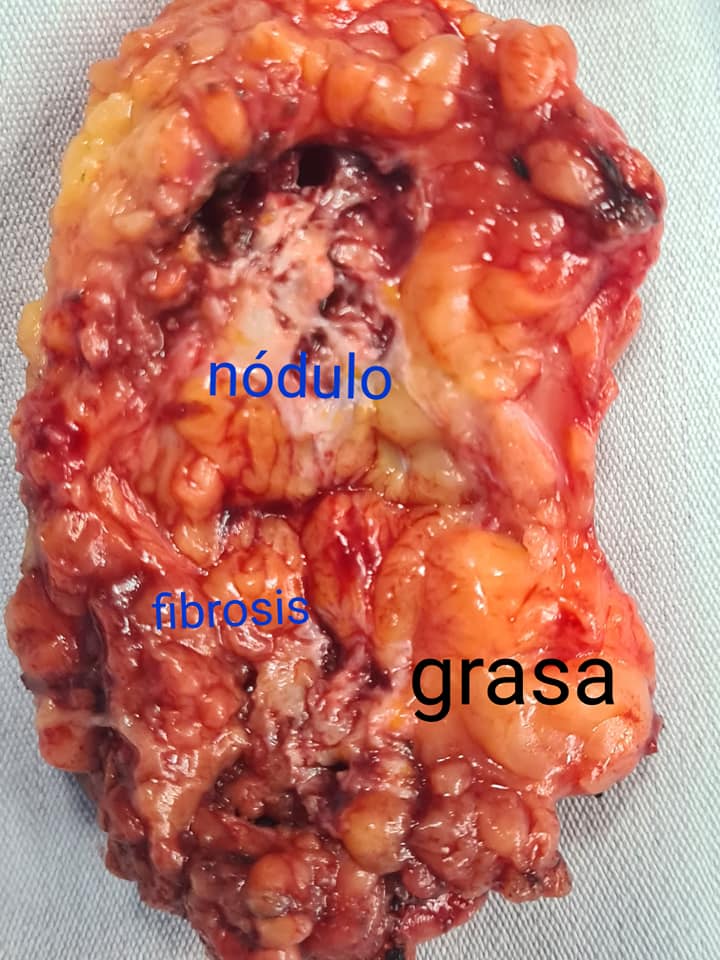 Nódulo de Endometriosis de 4 cms