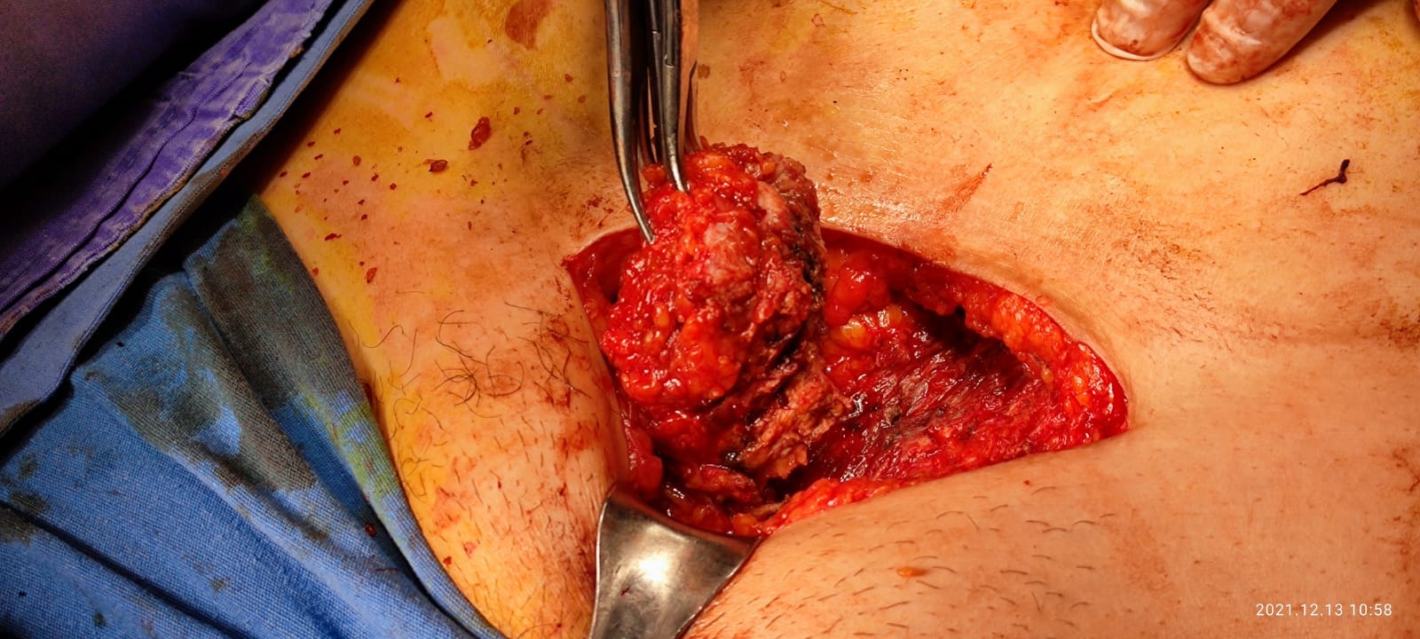 Paciente con dolor menstrual incapacitante