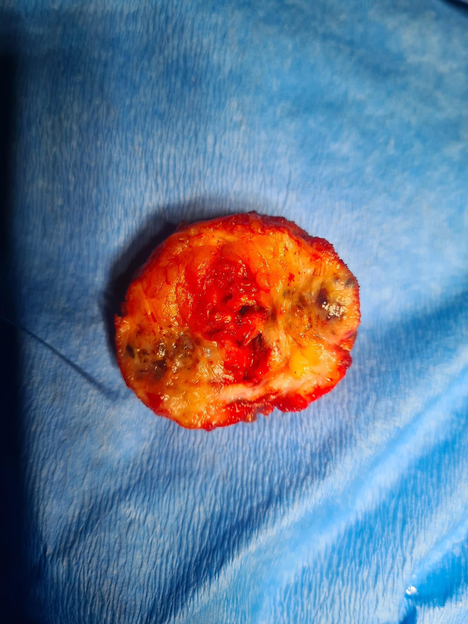 Nódulo endometriosis en pared abdominal de 2 cms