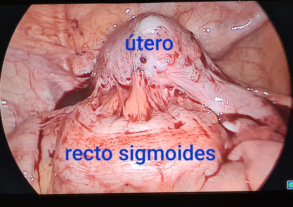 Cirugía de Endometriosis