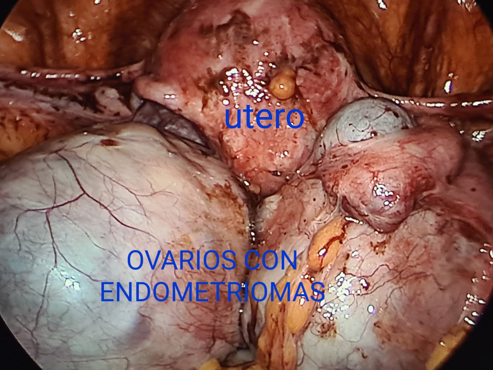 Paciente con dolor pélvico crónico
