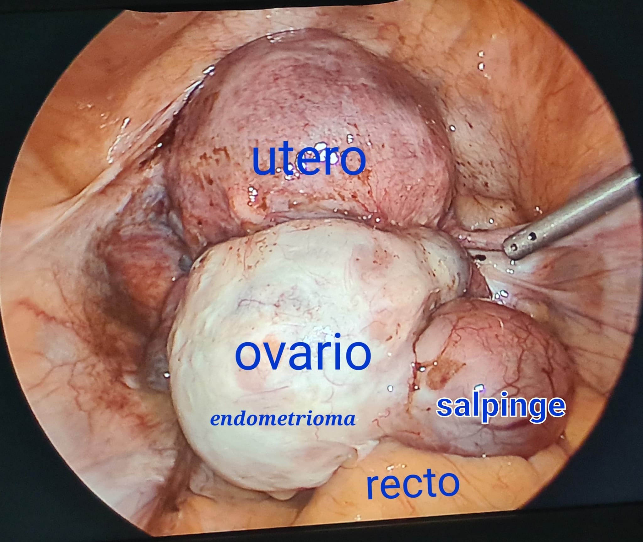 Paciente con 4 cirugías previas por endometriosis sin mejoría