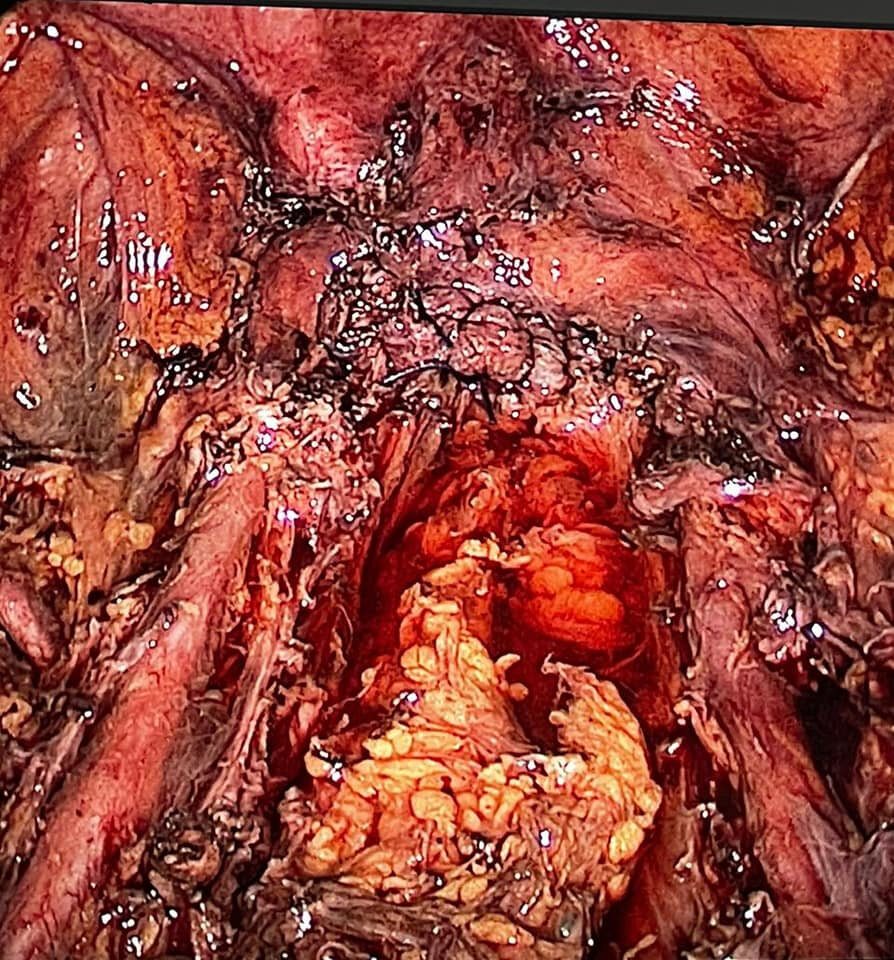 Paciente dismenorrea severa (dolor menstrual incapacitante)