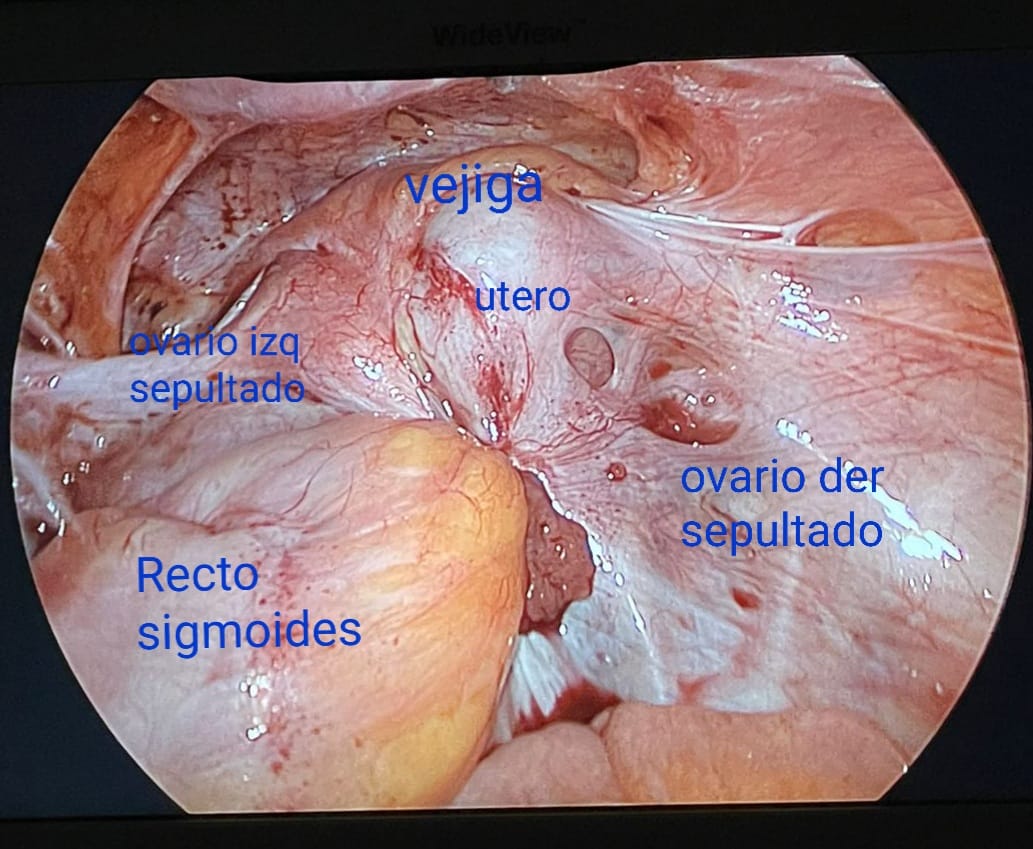 Pelvis congelada